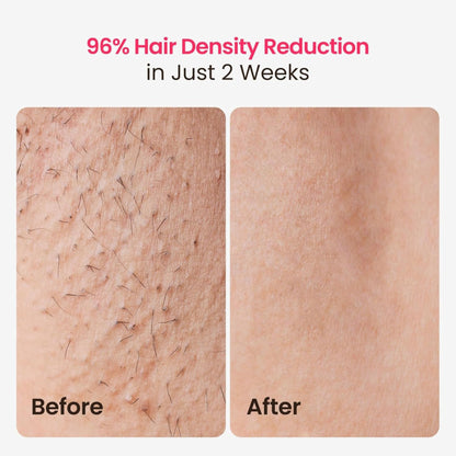 SilkNova™ Pro IPL Hair Removal Device